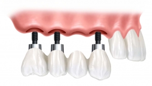 Despre implant dentar si osteointegrare